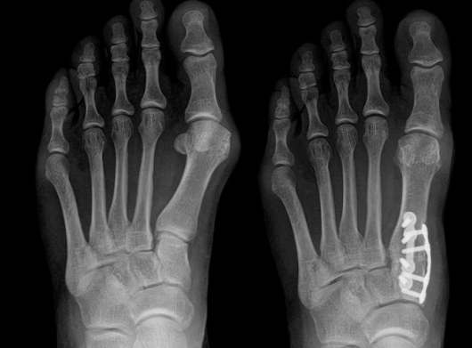 Bunionectomy and Lapiplasty