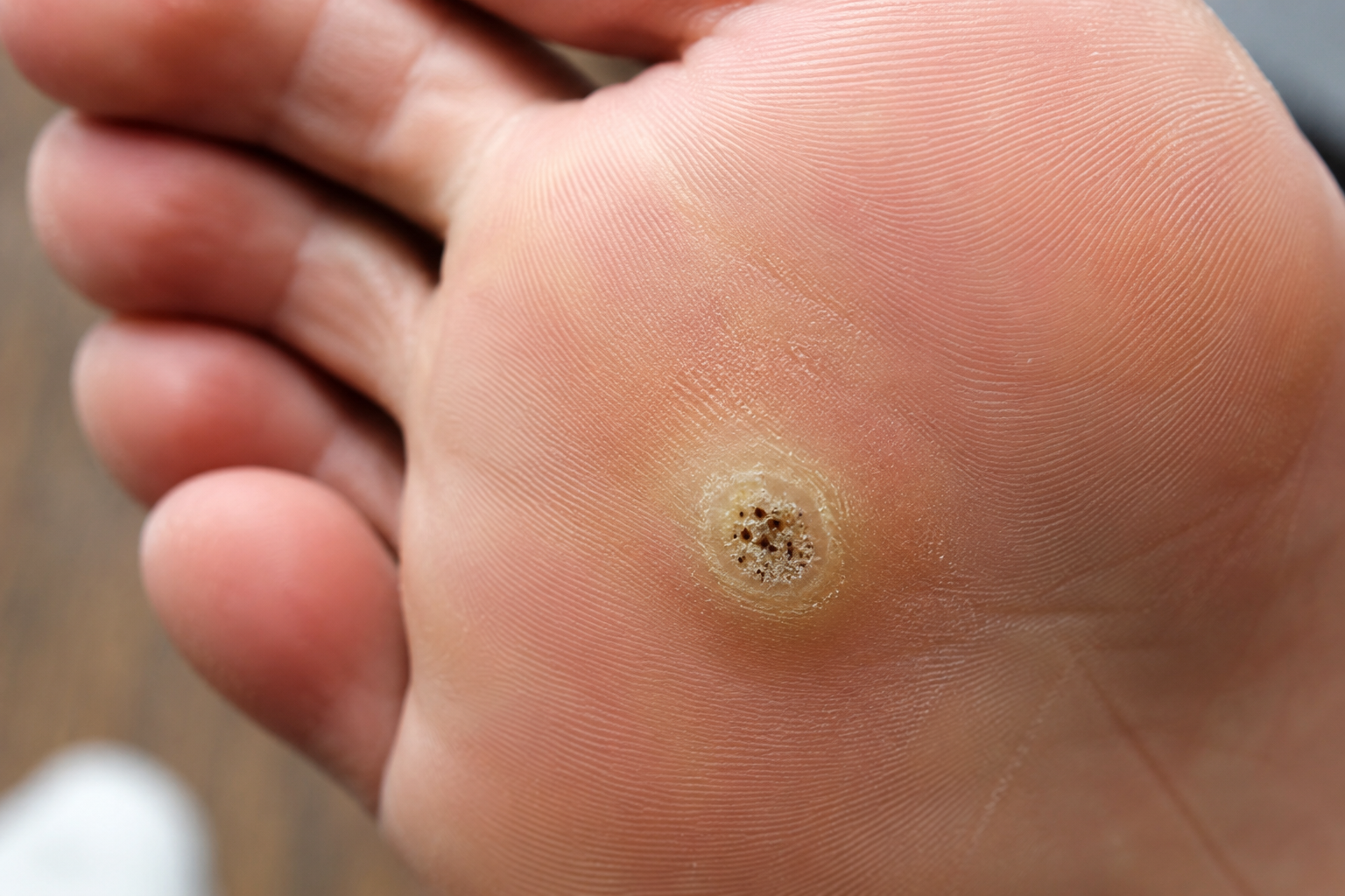 Plantar Wart